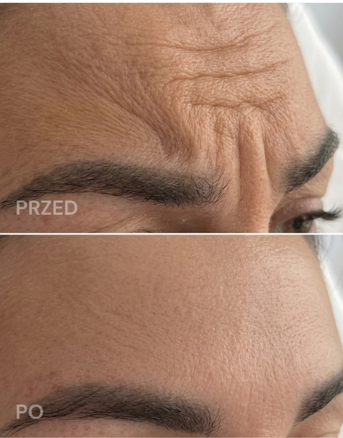 B-Tox — efekt przed i po zabiegu